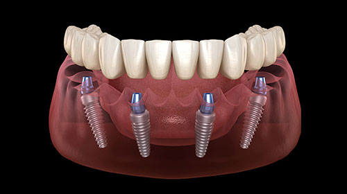 All on 4/6 Dental Implant Treatment