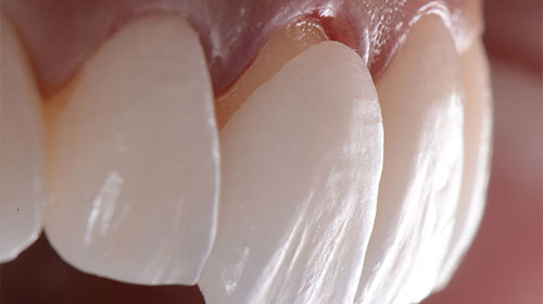 Full Ceramic Crown (EMAX)