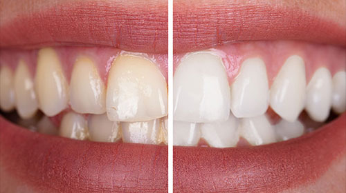 Teeth Whitening