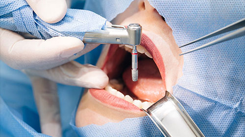 Oral and Maxillofacial Surgery