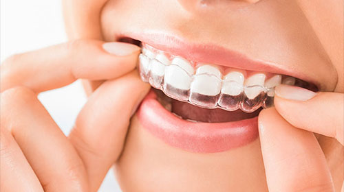 Orthodontic Invisible Aligners / Dental Braces