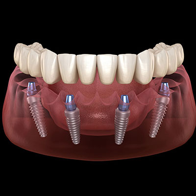All on 4/6 Dental Implant Treatment