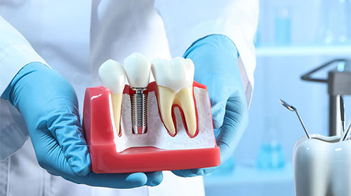 Dental Implants