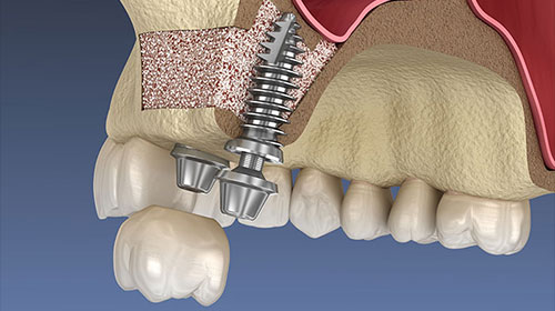 Sinus Lifting and Bone Augmentations