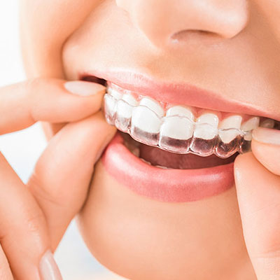 Orthodontic Invisible Aligners / Dental Braces