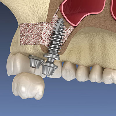 Sinus Lifting: Bone Insufficiency Treatment Before Implants